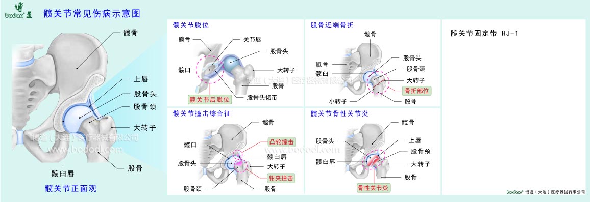 髖關(guān)節(jié)常見傷病示意圖