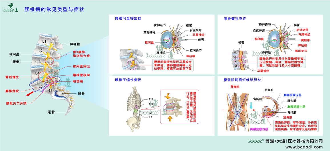 腰椎病的類(lèi)型與癥狀