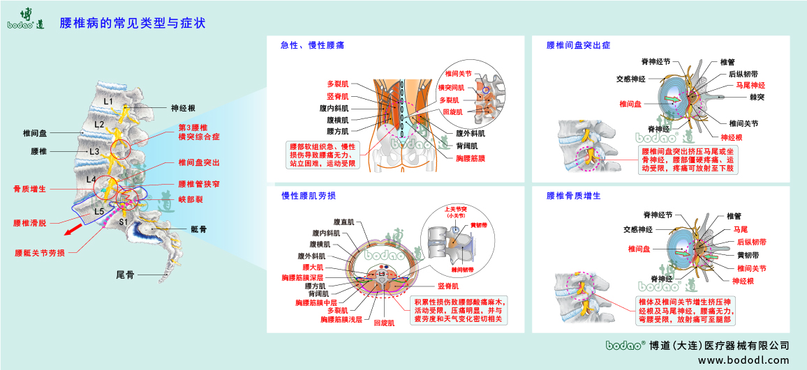 腰椎病的類型與癥狀