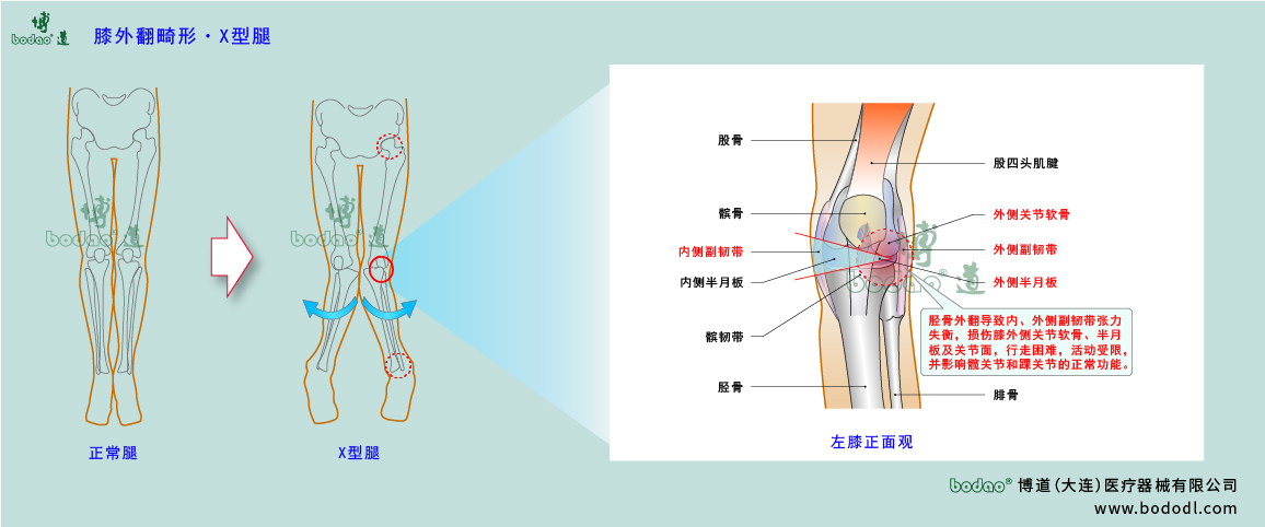 膝關節(jié)疾病的類型與癥狀