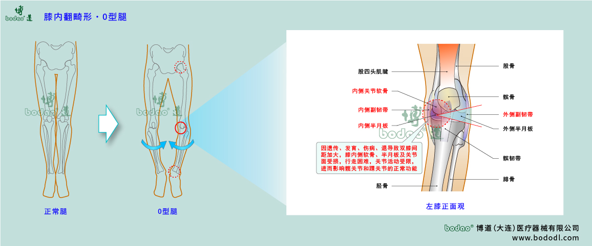 膝關(guān)節(jié)疾病的類(lèi)型與癥狀