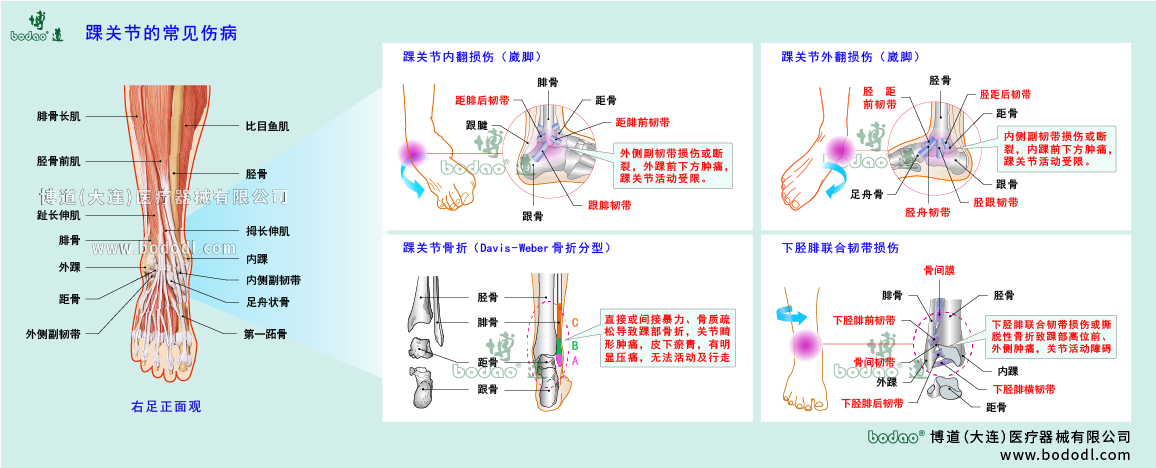 踝關(guān)節(jié)傷病的類型與癥狀