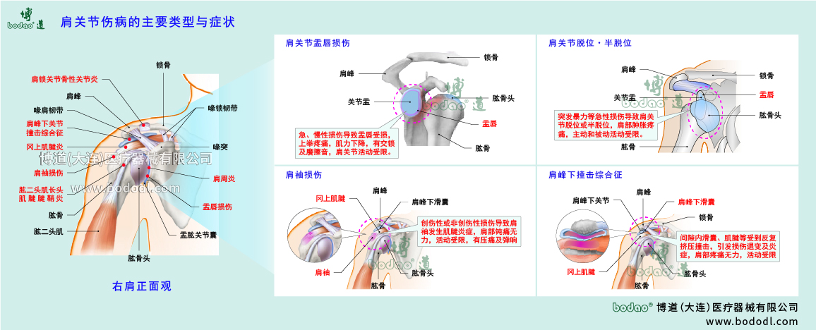 肩關(guān)節(jié)傷病的類型與癥狀