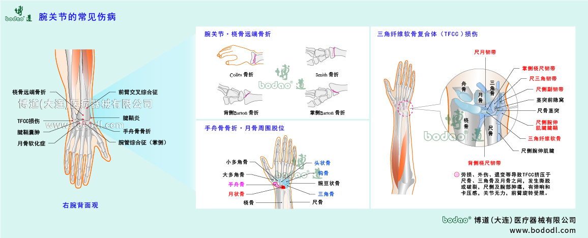 腕關(guān)節(jié)傷病的類型與癥狀