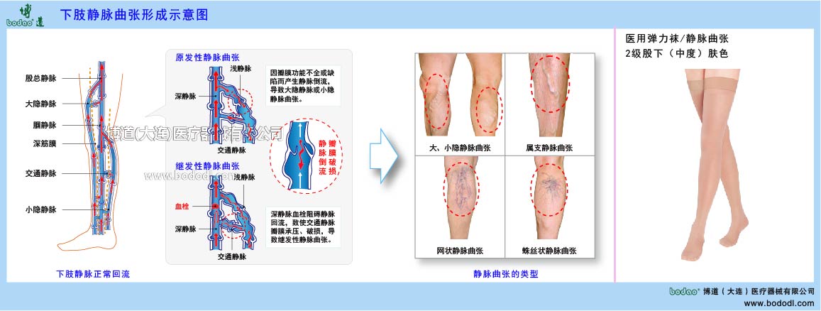 下肢靜脈曲張與健康防護(hù)