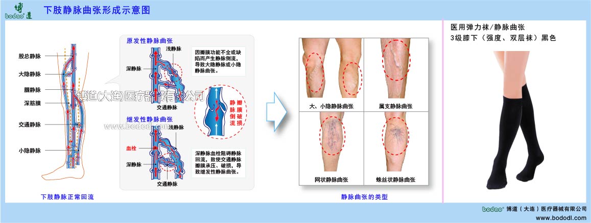 下肢靜脈曲張與健康防護(hù)