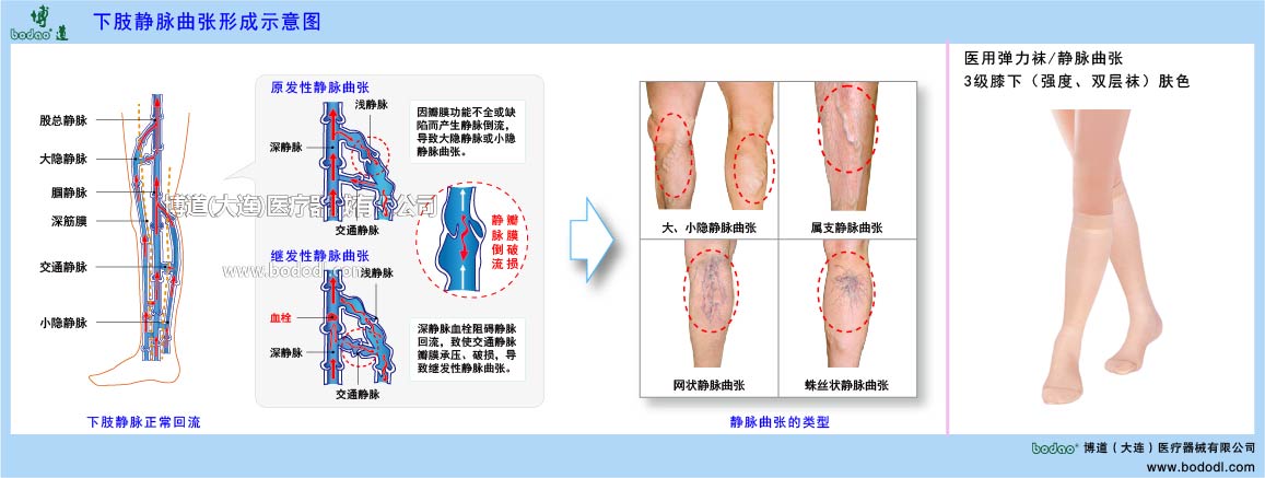 下肢靜脈曲張與健康防護