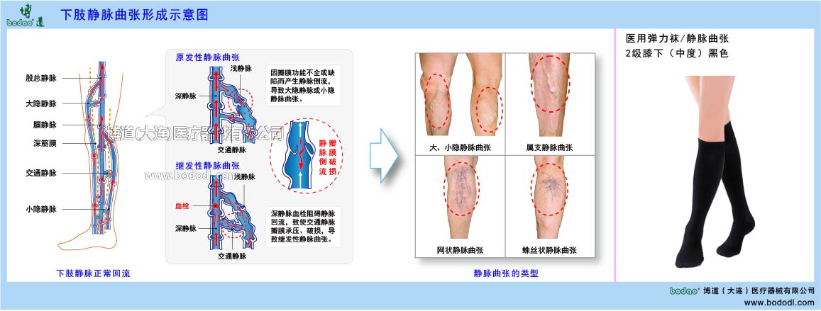 下肢靜脈曲張與健康防護