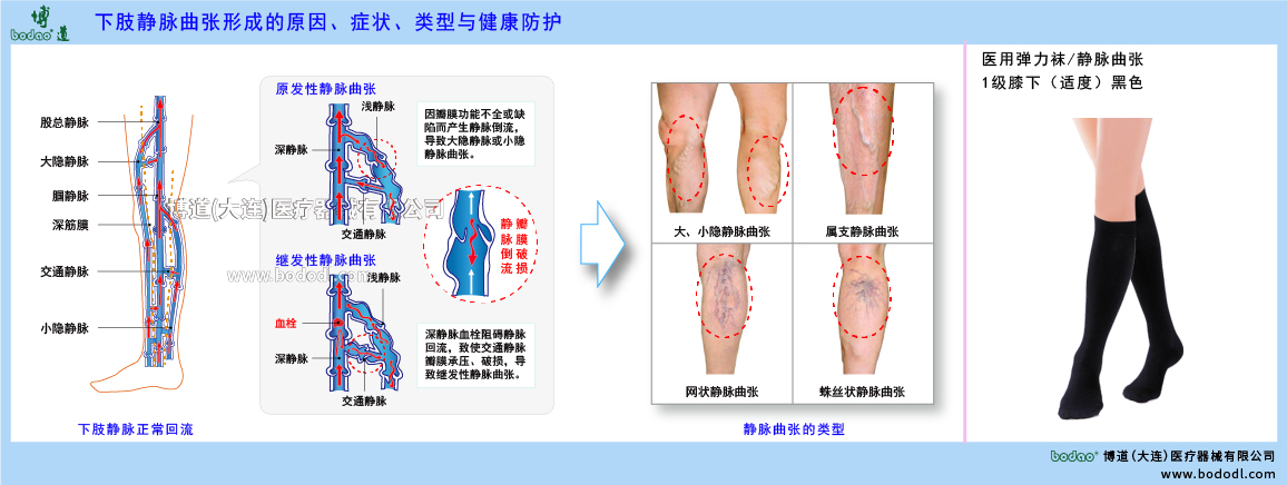 下肢靜脈曲張與健康防護(hù)