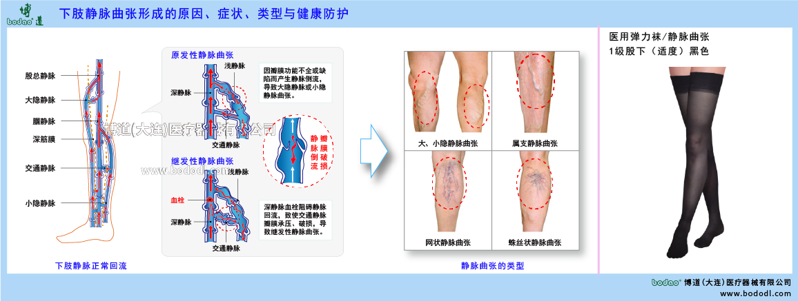 下肢靜脈曲張與健康防護