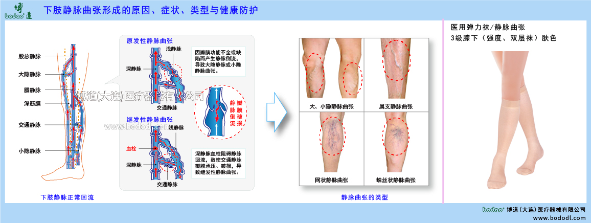 下肢靜脈曲張與健康防護