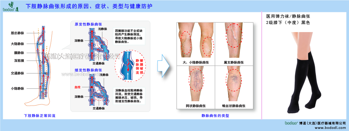 下肢靜脈曲張與健康防護