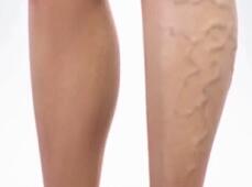 不知靜脈血栓的可怕性？